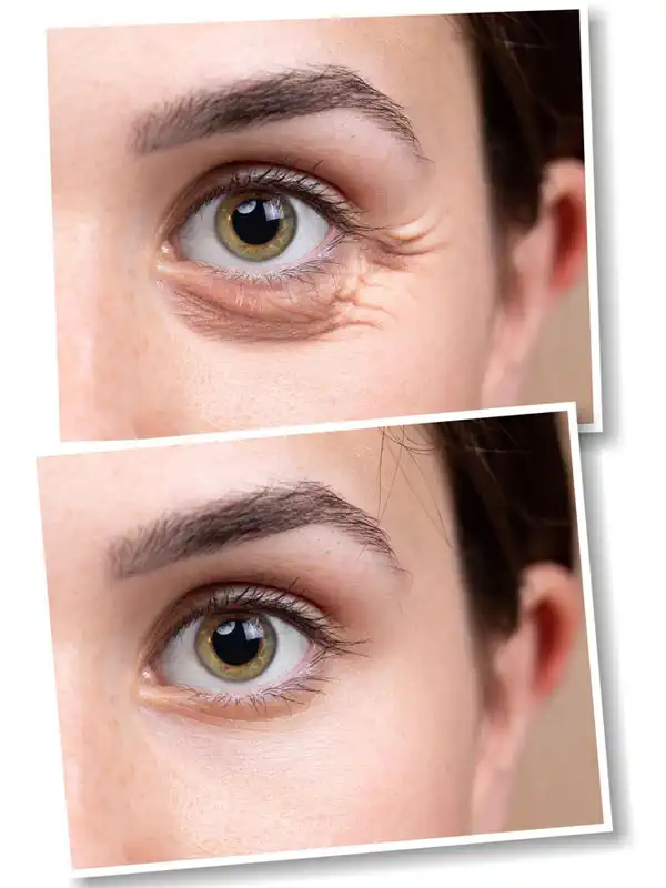 Blepharoplasty